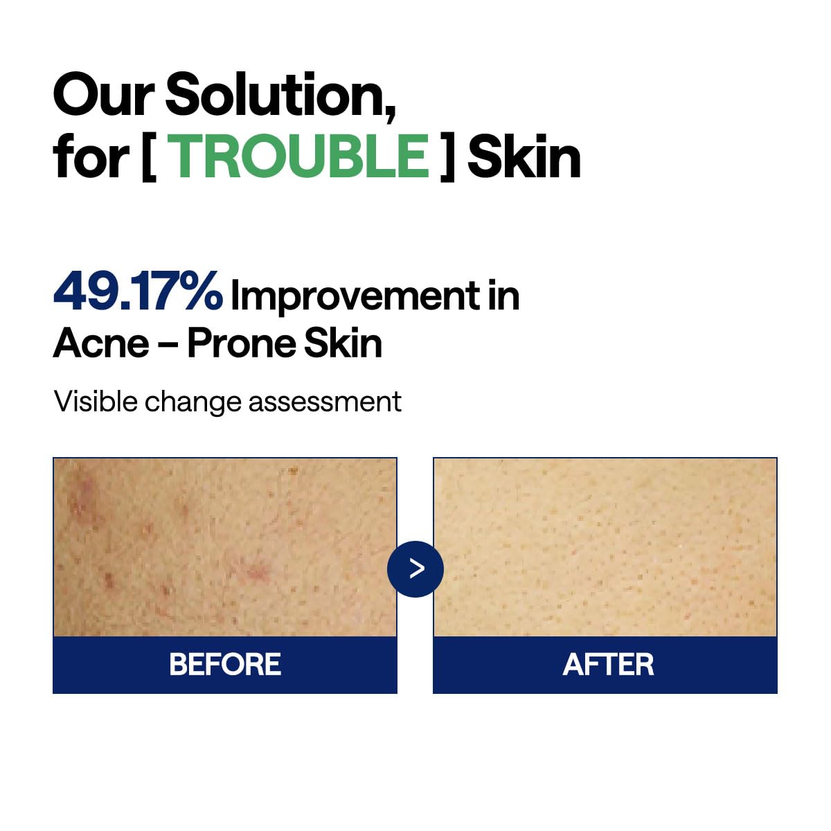 MEDIHEAL tea tree ingredient focus highlighting calming botanical support