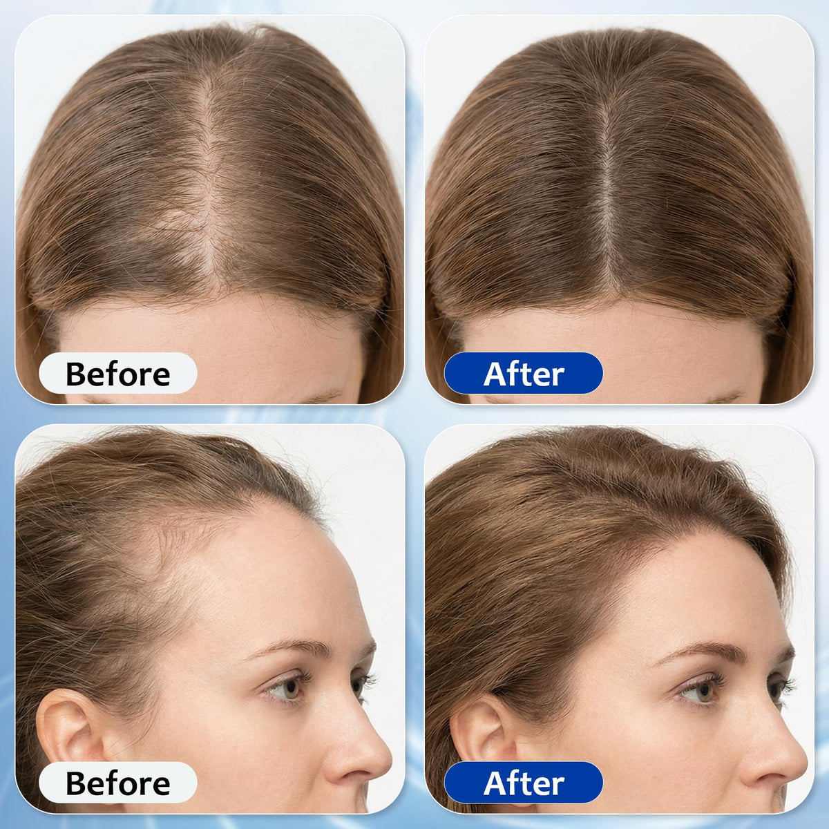 MGVAASURC applying roll-on to thinning scalp area for targeted nourishment