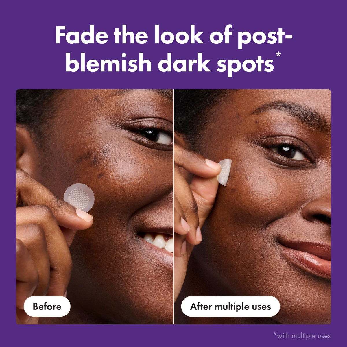 Mighty Patch applied on healed blemish demonstrating discreet coverage and targeted treatment