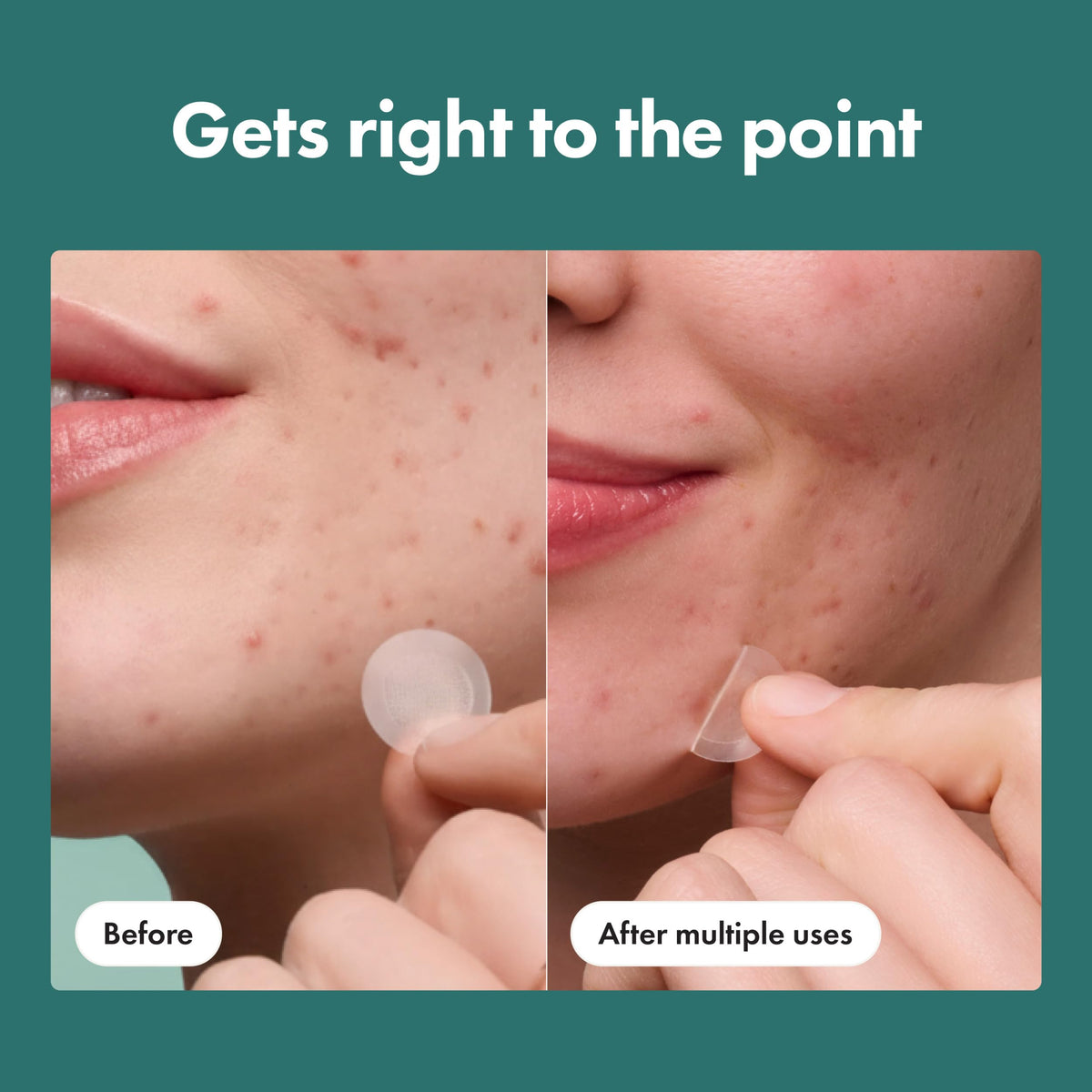 Mighty Patch HERO ingredients display with salicylic acid and niacinamide benefits