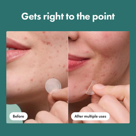 Mighty Patch HERO ingredients display with salicylic acid and niacinamide benefits