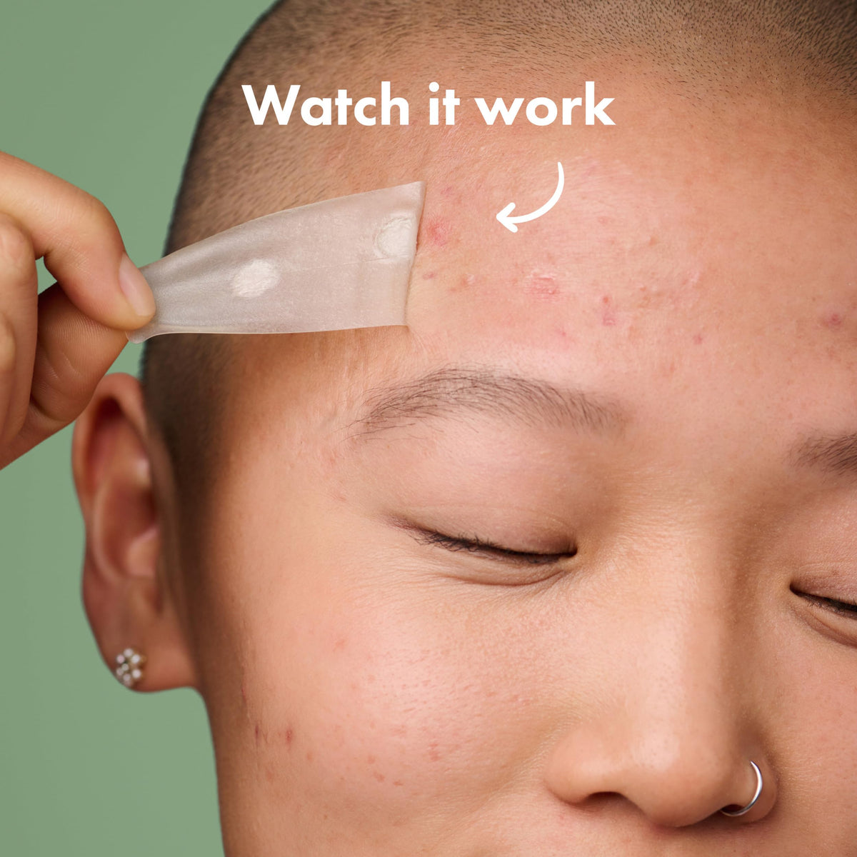 Mighty Patch applied on cheek demonstrating broad blemish coverage benefit