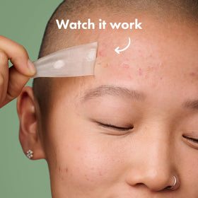 Mighty Patch applied on cheek demonstrating broad blemish coverage benefit