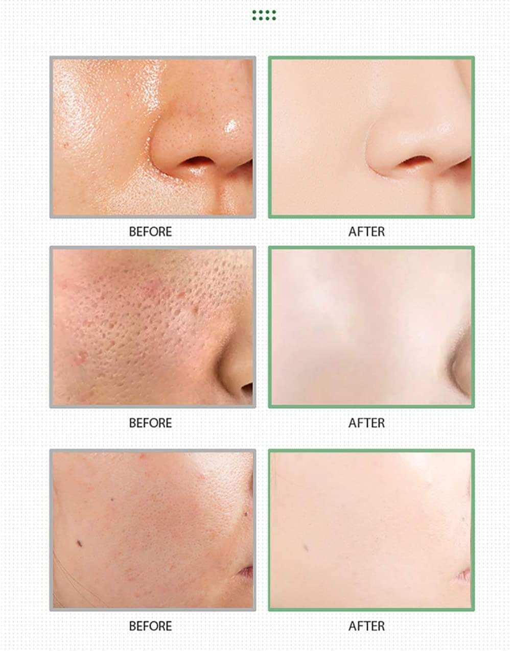 MISEDI application on T-zone demonstrating targeted pore cleansing benefit