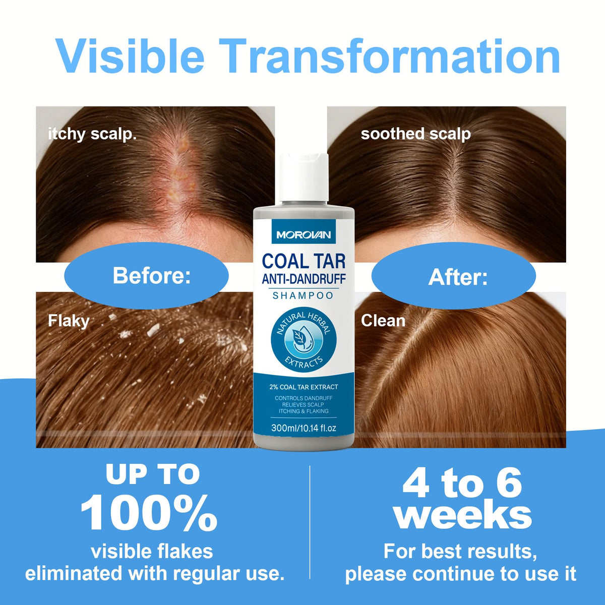 Before and after scalp showing reduced flaking with Morovan treatment