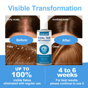 Before and after scalp showing reduced flaking with Morovan treatment