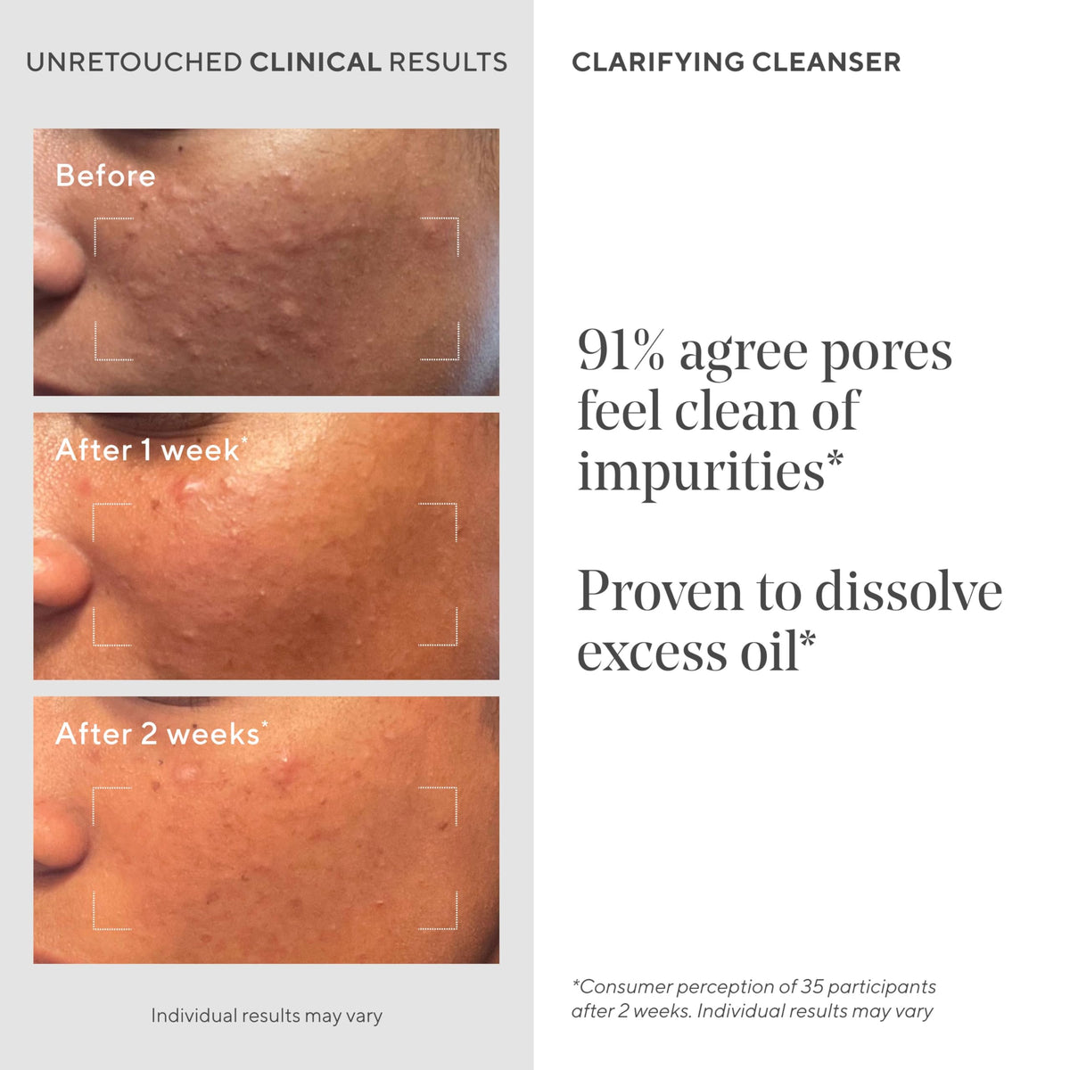 Murad salicylic acid closeup illustrating targeted pore exfoliation benefit