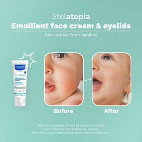 Mustela Stelatopia applied to baby cheek for soothing and hydration