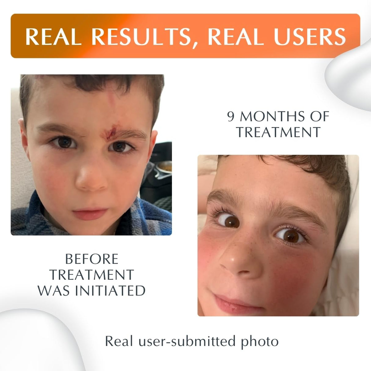 Applying MyNewGel on hand scar for targeted protection and care