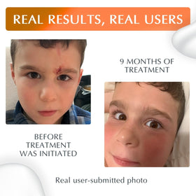 Applying MyNewGel on hand scar for targeted protection and care