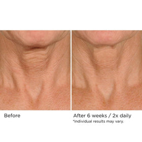 NASSIFMD application on neck demonstration for targeted lifting benefit