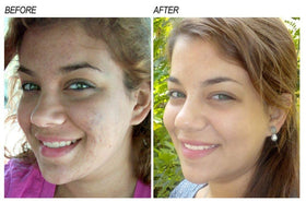 Neoprosone serum dropper dispensing a clear drop for precise application