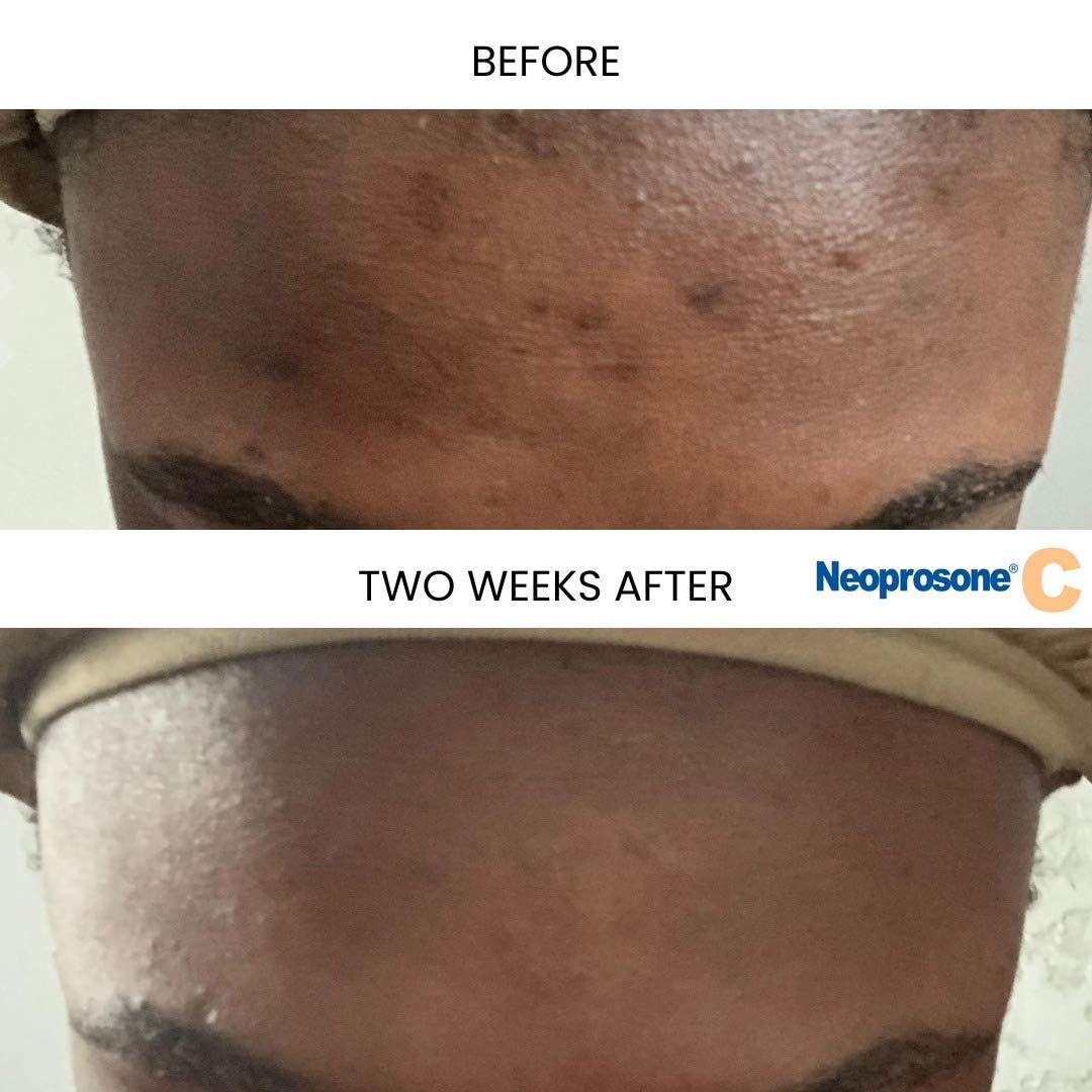 Neoprosone lightweight serum texture on skin absorbed for smooth finish