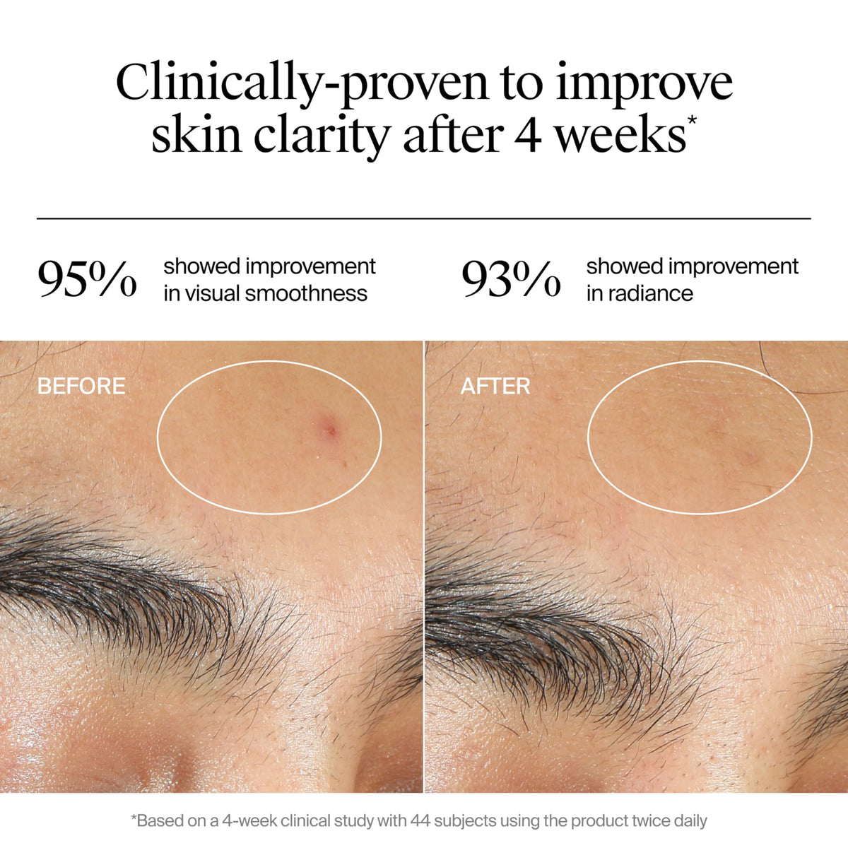 Neutrogena application on face showing spot treatment and quick absorption