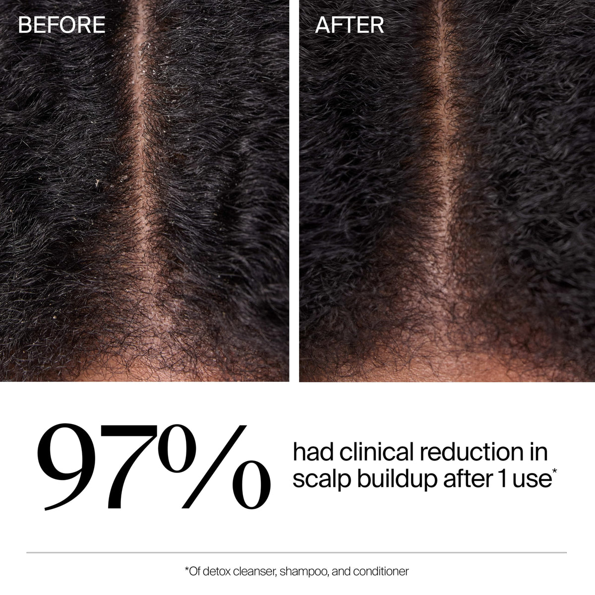 Neutrogena before and after scalp image indicating reduced buildup and cleaner roots benefit