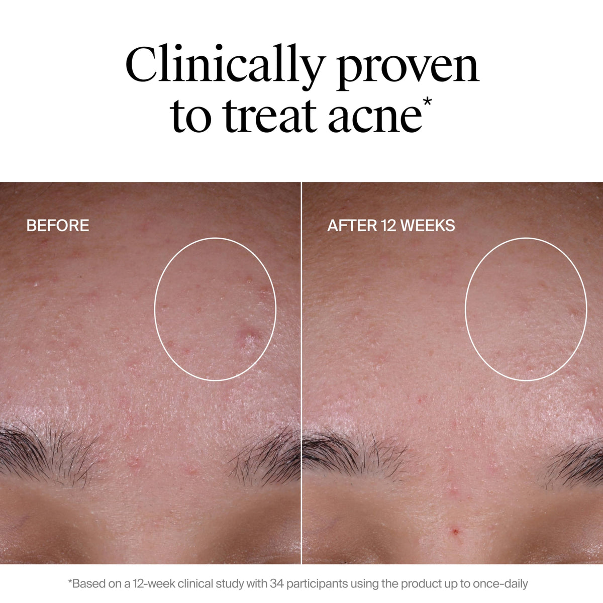 Neutrogena conceptual before and after image indicating faded post-acne marks