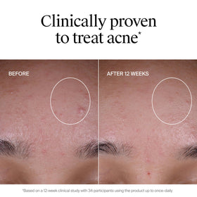 Neutrogena conceptual before and after image indicating faded post-acne marks