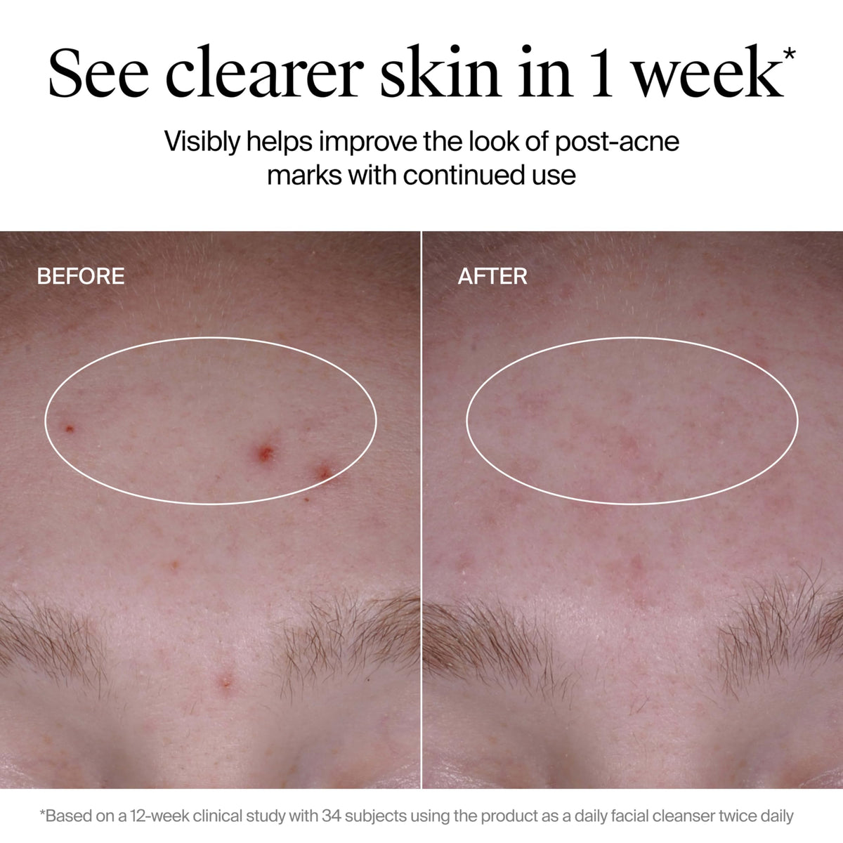 Neutrogena ingredient highlight showing salicylic acid detail, pore-clearing benefit