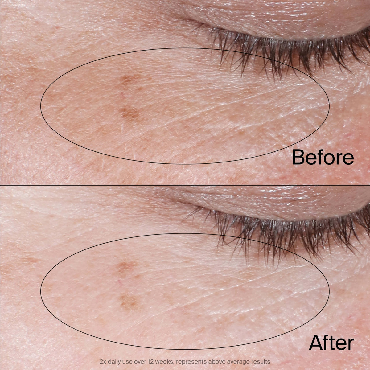 Neutrogena illustrative before and after under-eye photo demonstrating visible improvement