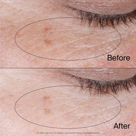 Neutrogena illustrative before and after under-eye photo demonstrating visible improvement