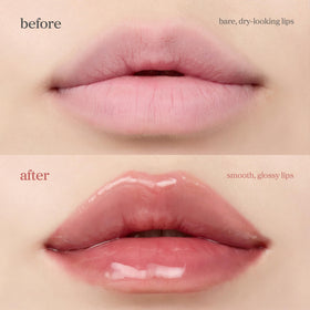 NOONI lip before and after showing visible smoothing and subtle plump