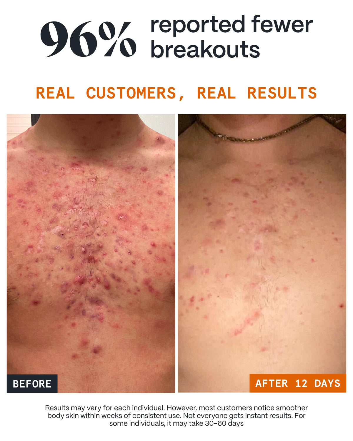 Norse Organics application on shoulder demonstrating targeted acne care