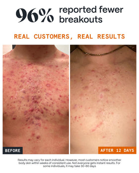 Norse Organics application on shoulder demonstrating targeted acne care