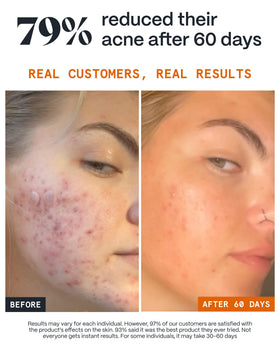 Norse Organics Scar Healer applied to spot for targeted scar and mark care