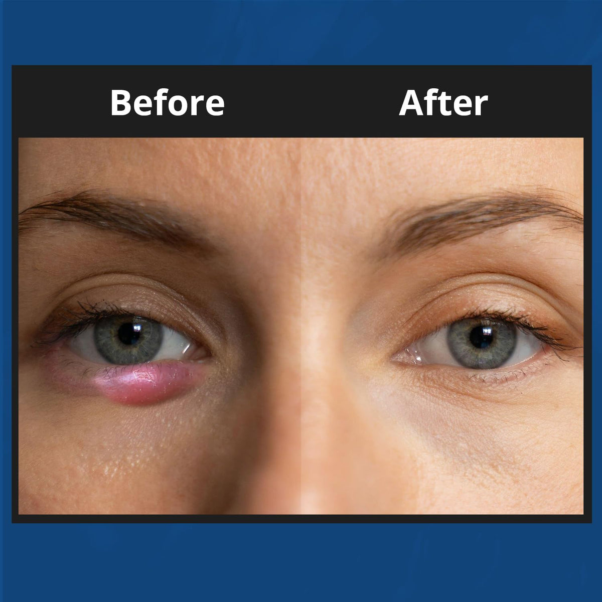 NOVEHA application on eyelid with gentle massage illustrating safe daily use