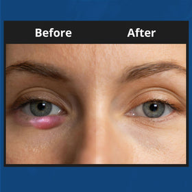 NOVEHA application on eyelid with gentle massage illustrating safe daily use
