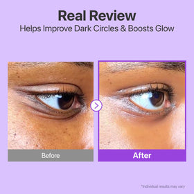 numbuzin No.9 before and after under-eye photo demonstrating reduced puffiness