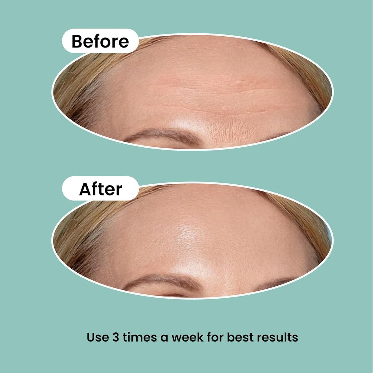 NURIVE patch on hand for scale showing large size fits broad forehead creases effectively
