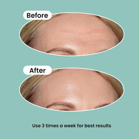NURIVE patch on hand for scale showing large size fits broad forehead creases effectively