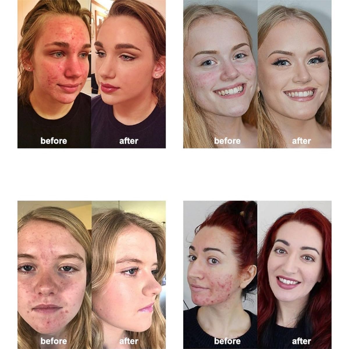 nvyue PHOERA before and after showing coverage benefit on uneven skin tone