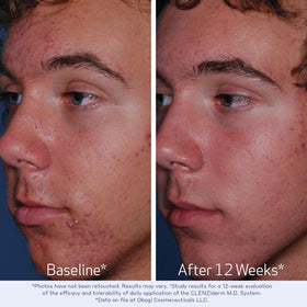 Clear liquid texture on hand from Obagi Medical illustrating quick absorption and gentle exfoliation