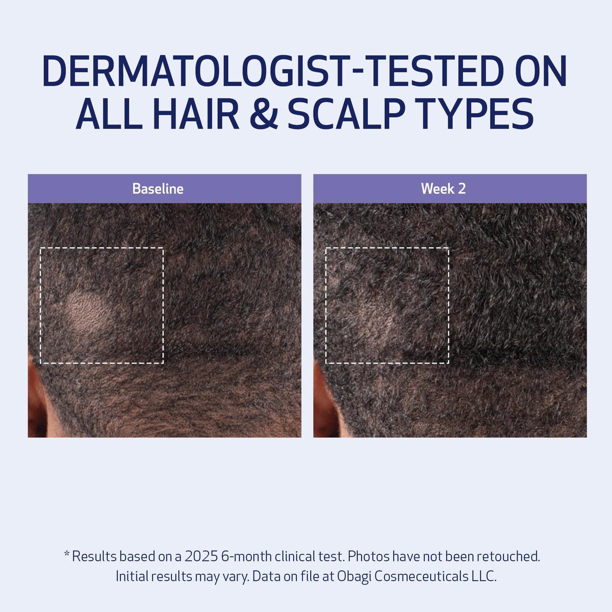 Obagi Medical being applied to scalp to stimulate circulation and distribute evenly