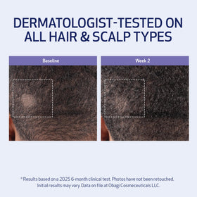 Obagi Medical being applied to scalp to stimulate circulation and distribute evenly