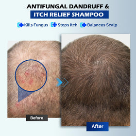 oely before and after scalp comparison showing visible reduction in flaking