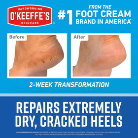 O'Keeffe's cream applied to heel demonstrating targeted hydration