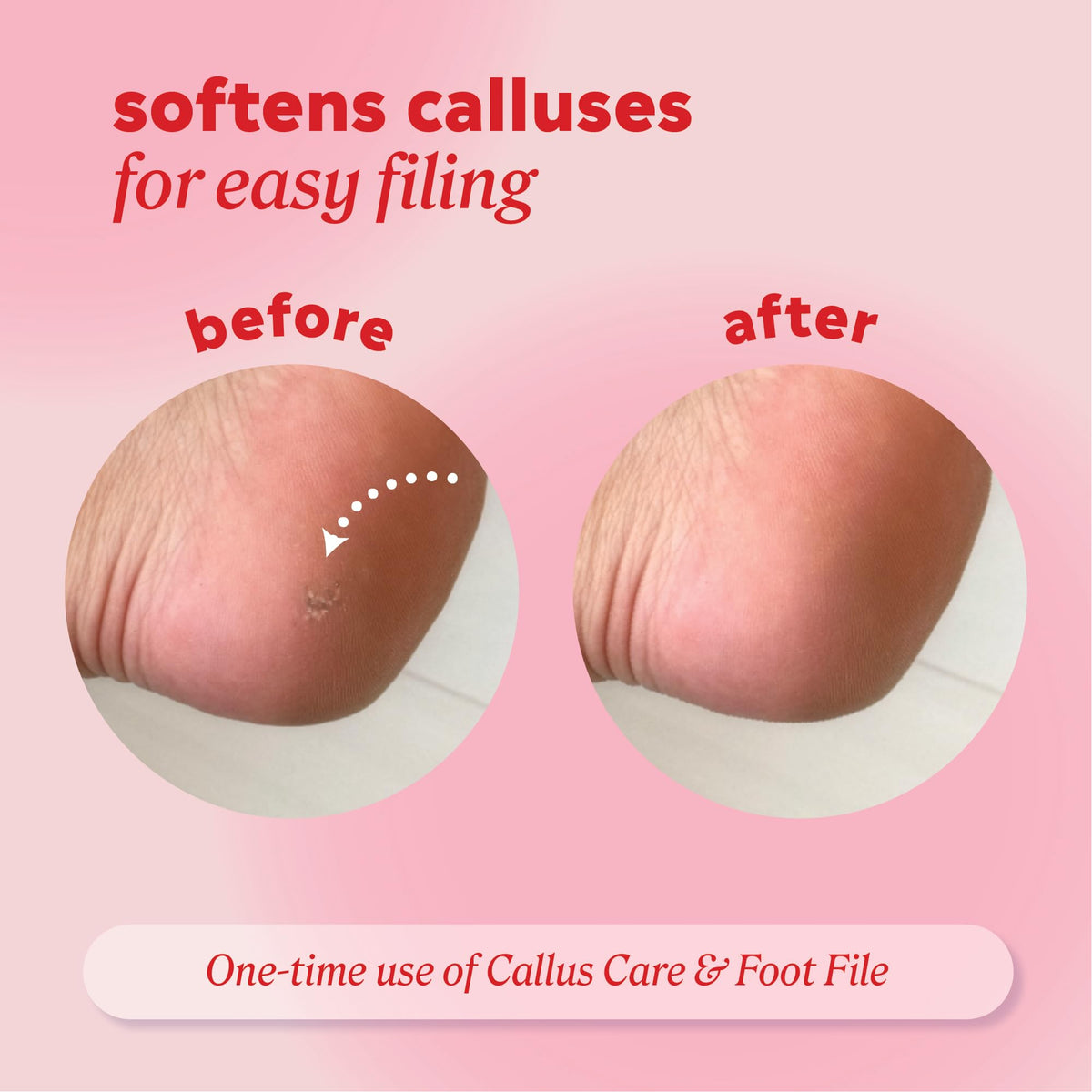 Onyx Professional being applied to heel demonstrating targeted callus softening