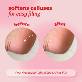 Onyx Professional being applied to heel demonstrating targeted callus softening