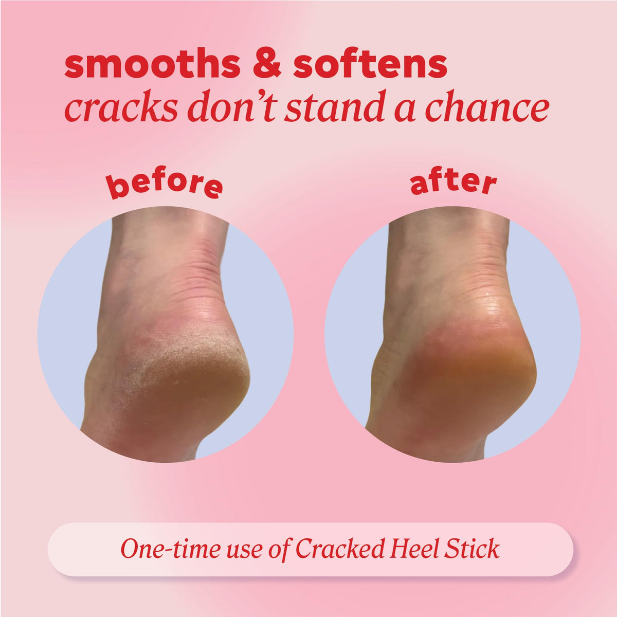 Onyx Professional in use on heel offering targeted relief for cracked skin