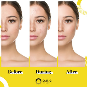 O.R.G. before and after skin showing refined pores and brighter texture