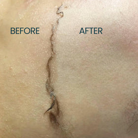 Ouiloe in use during dermaplaning demonstrating smoother razor glide