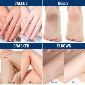 OUKEYA before and after feet comparison showing reduced roughness