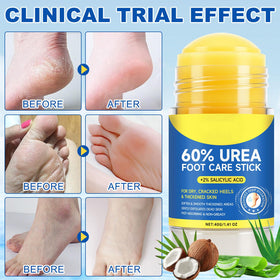 OUYOFI before and after feet visual illustrating softer, smoother skin benefit