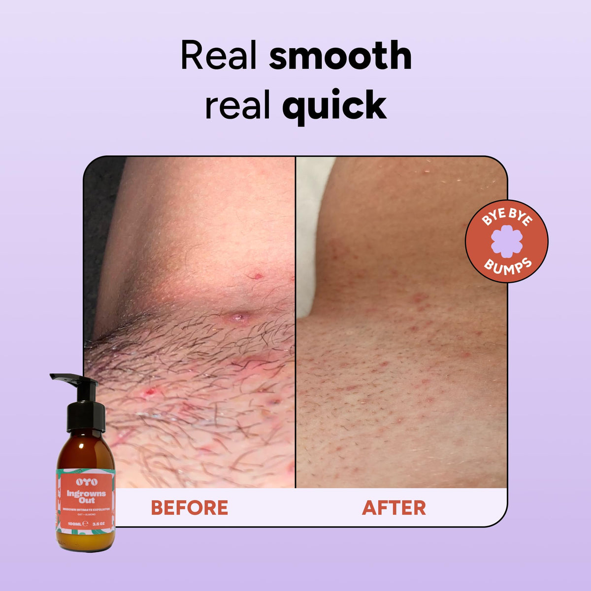 OYO applied to bikini line demonstrating gentle exfoliation benefit