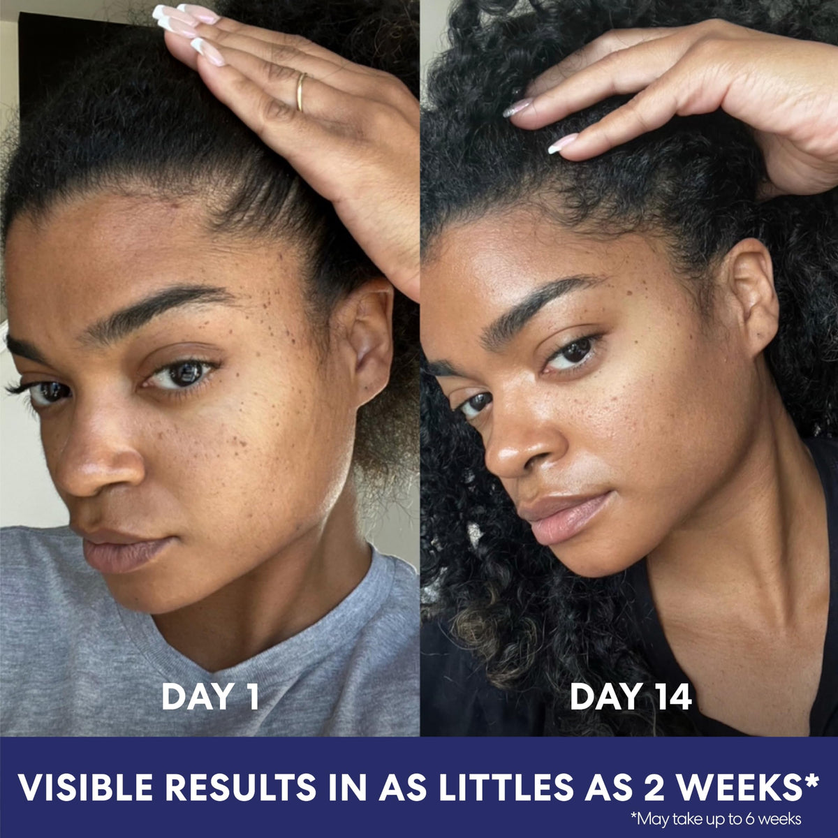 Palmer's illustration of fading dark spots before and after consistent use