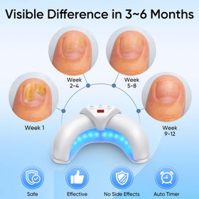 PANIMOSI device treating toenails hands-free for convenient at-home care