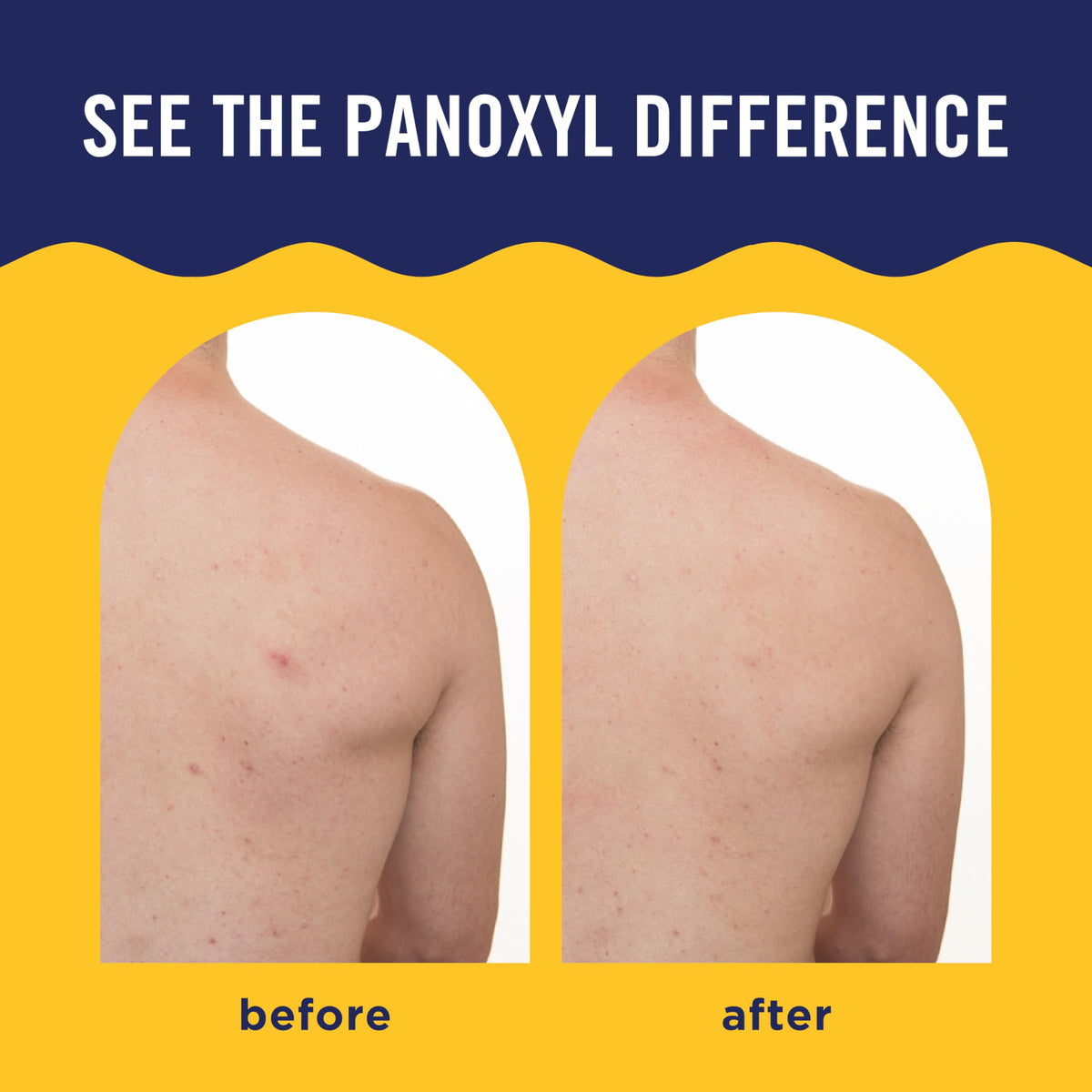 PanOxyl ingredients close-up highlighting niacinamide and vitamin C benefits